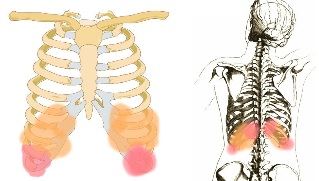 Rückenschmerzen ënner de rippen Symptomer.