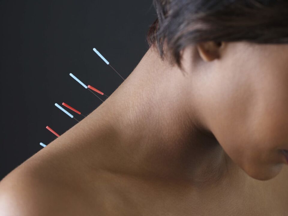 Akupunktur fir zervikal Osteochondrose eliminéiert entzündlech Prozesser